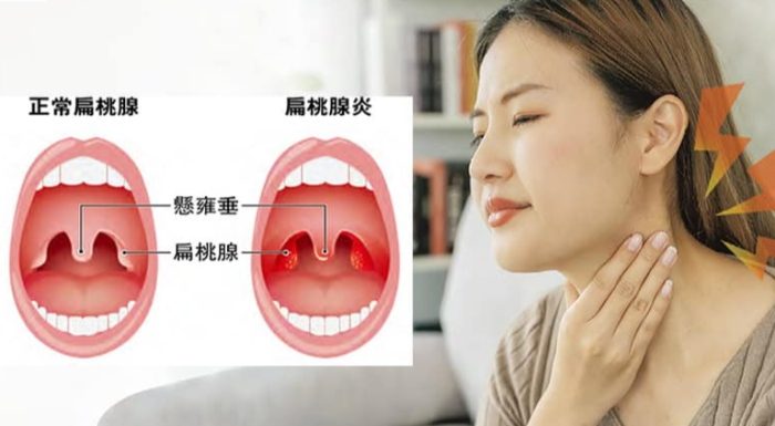 扁桃腺结石怎么清