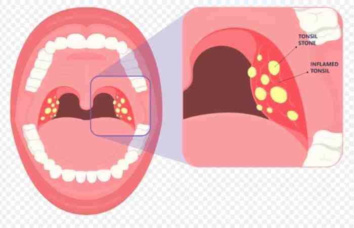 扁桃腺结石原因