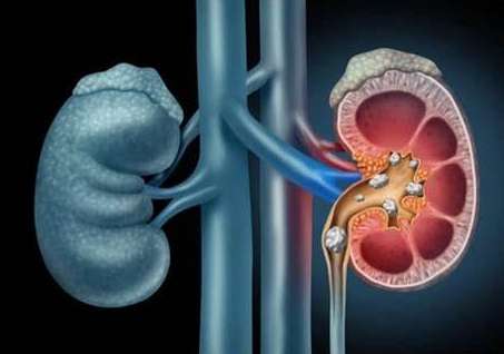 尿道結石可以吃什麼