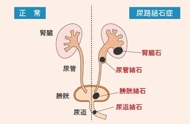 膀胱結石怎麼治療