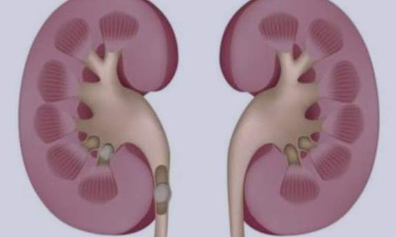 尿道結石手術費用