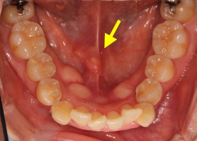 唾液腺結石治療