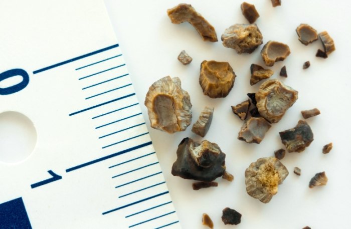 輸尿管結石原因