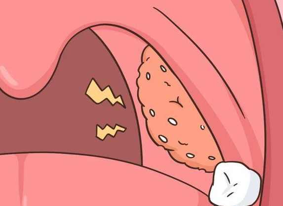 扁桃腺結石症狀