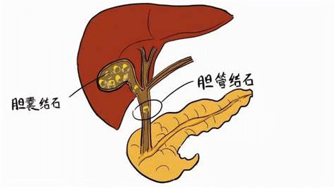 膽結石症狀
