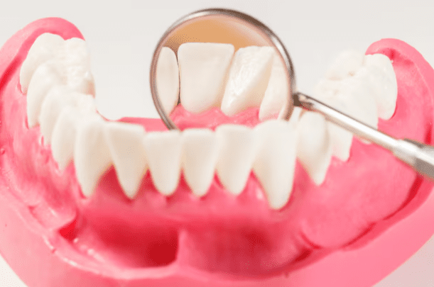 牙結石注意事項