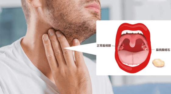 扁桃腺結石手術