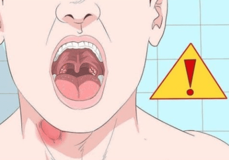 扁桃腺結石預防方法