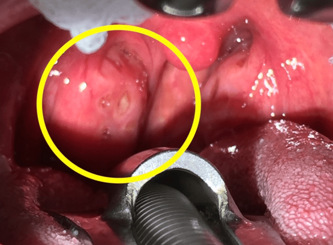 如何自行清理扁桃腺結石