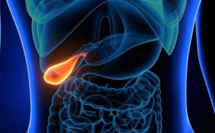 膽結石一定要開刀嗎