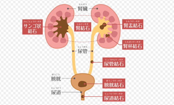腎結石腰痛位置
