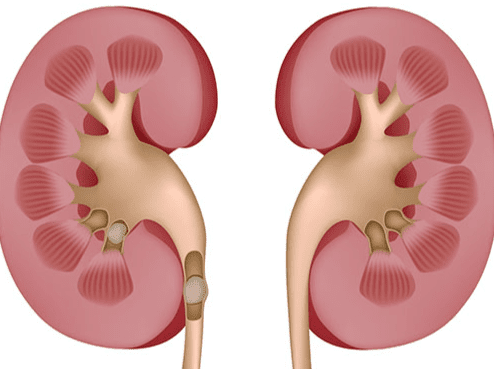 腎結石去除方法