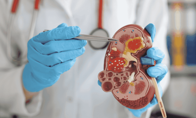 腎結石手術風險