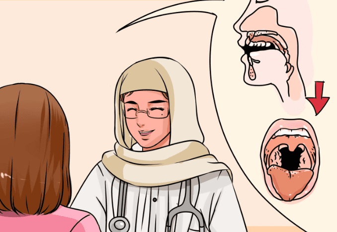 扁桃腺結石危害