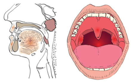 扁桃腺結石手術風險