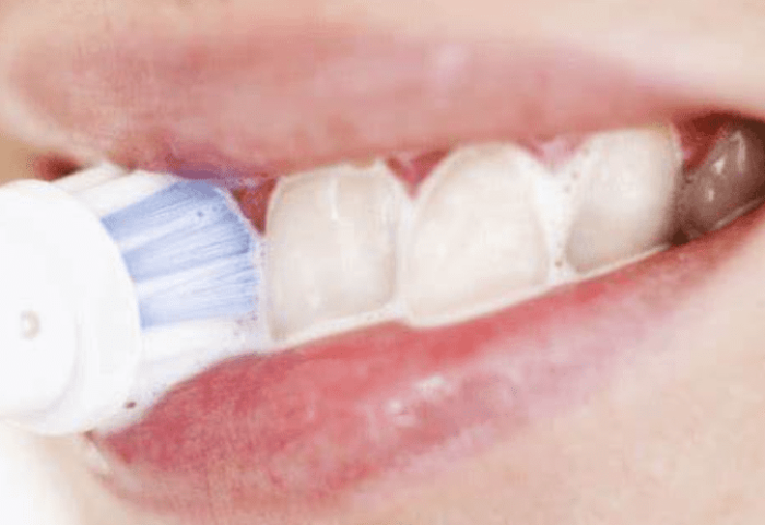 牙結石發生位置