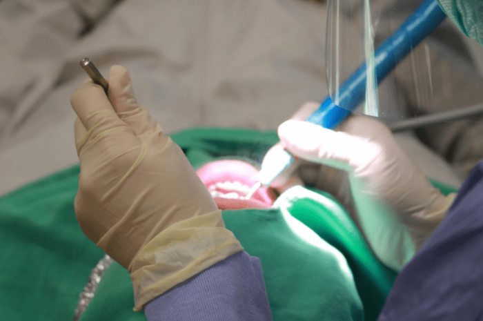 牙結石手術風險