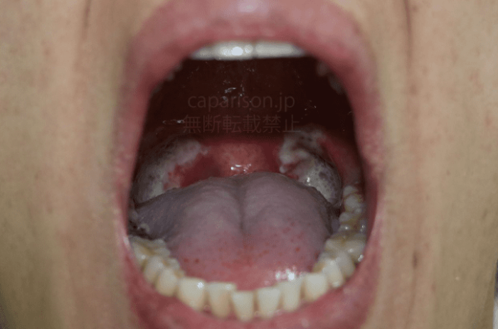 扁桃腺結石飲食食譜