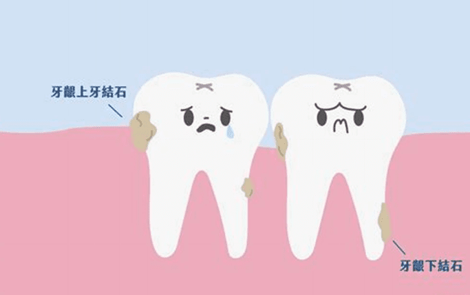 牙結石危險因子