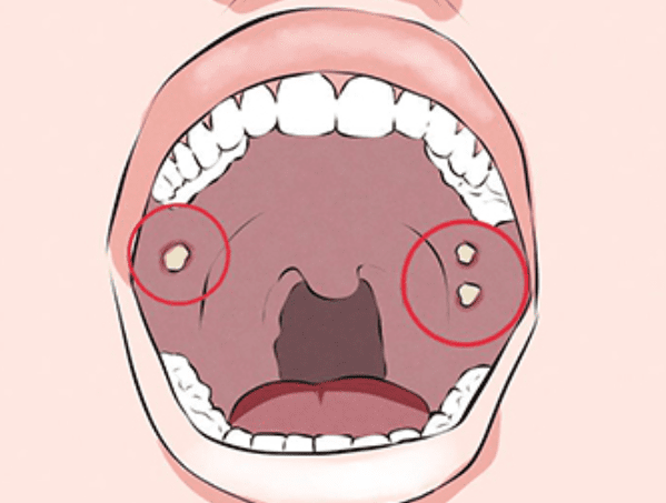 扁桃腺結石檢查方式