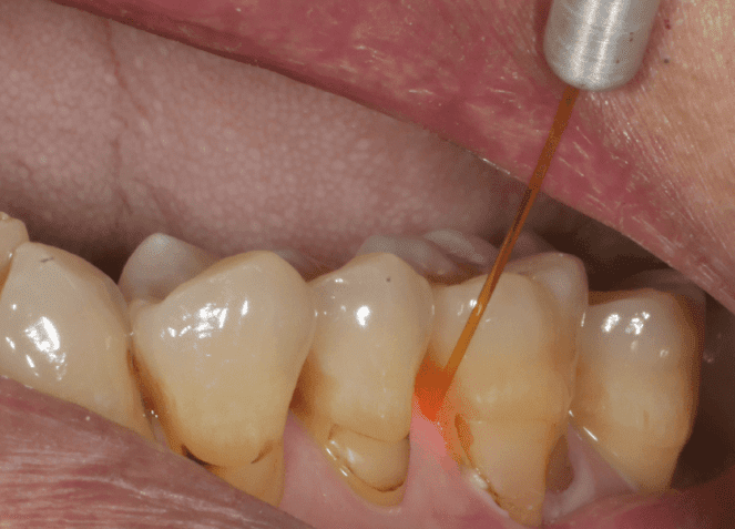 牙結石檢查方式