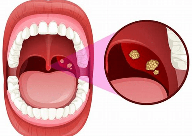 扁桃腺結石危險因子