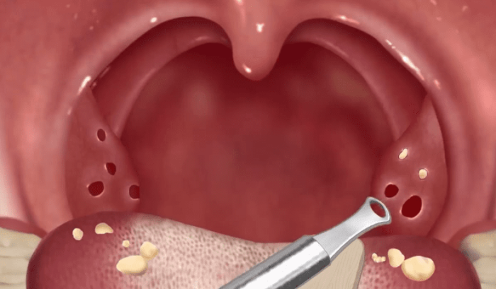 扁桃腺結石形成原因