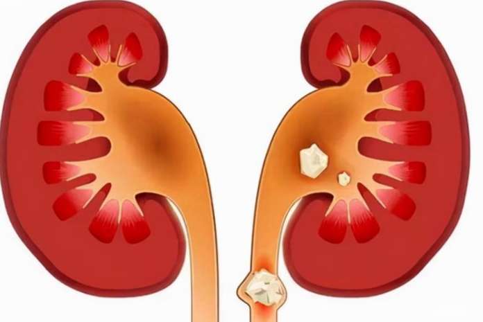 腎結石怎麼才能快速排出來